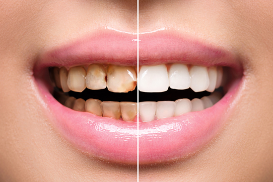 Scaling and Polishing By Mr and Mrs Dentist